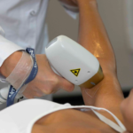 Estética não invasiva impulsiona depilação a laser