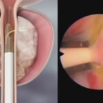 Tratamento de próstata: agora disponível em Bauru