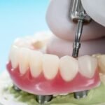 Implante zigomático garante tratamento ágil a pacientes