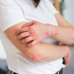 Sujeira acumulada em sofás pode desencadear alergias de pele