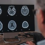 Maio Cinza: mês reforça a conscientização sobre o câncer cerebral