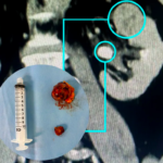Nefrectomia robótica preserva rins com alta precisão