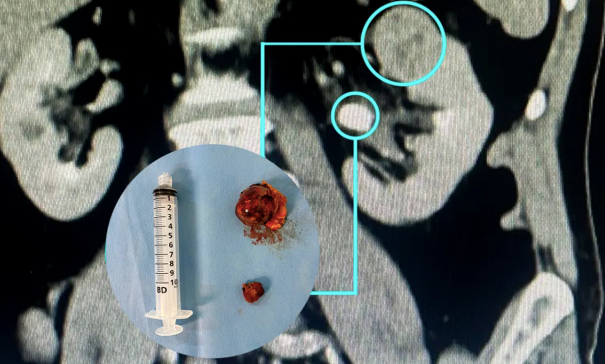Nefrectomia robótica preserva rins com alta precisão